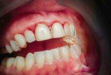 Photo of Gingivitis Gums: What it is, Symptoms, Causes, treatment, and prevention