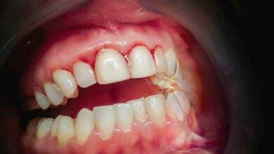 Photo of Gingivitis Gums: What it is, Symptoms, Causes, treatment, and prevention