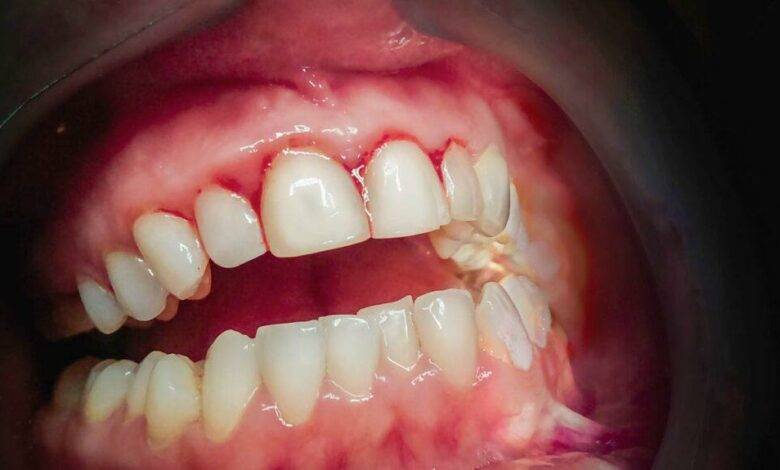 gingivitis-gums: open-gingivitis-mouth.