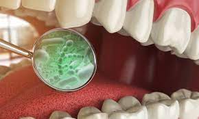 gingivitis-gums: mouth-bacteria