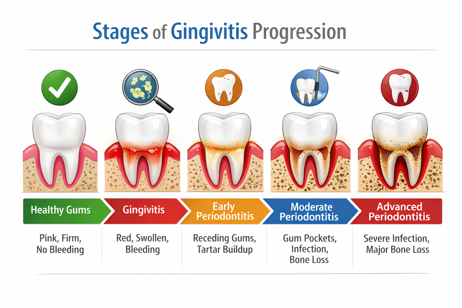 Stages of gingivitis progression illustrated
